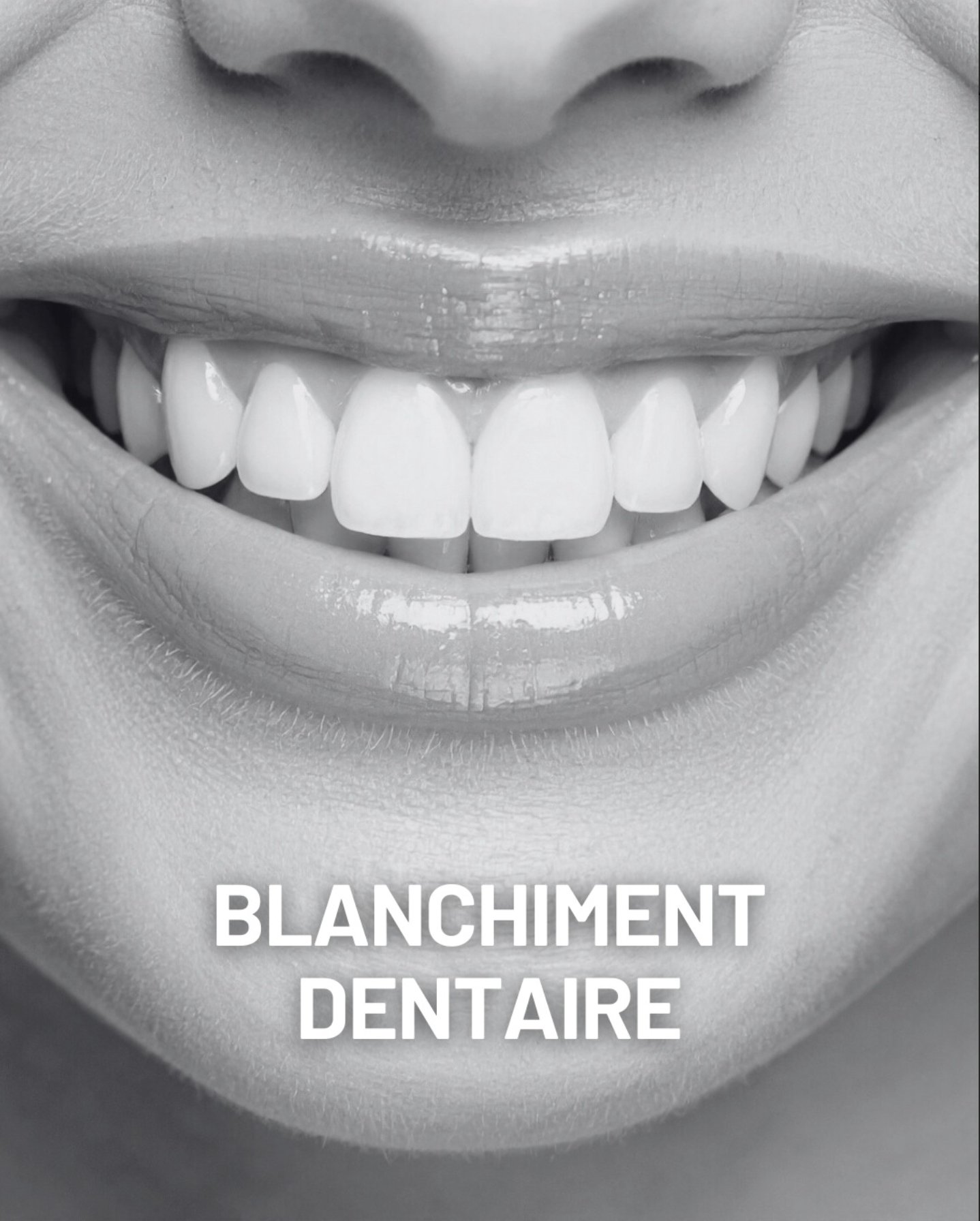 Blanchiment des dents